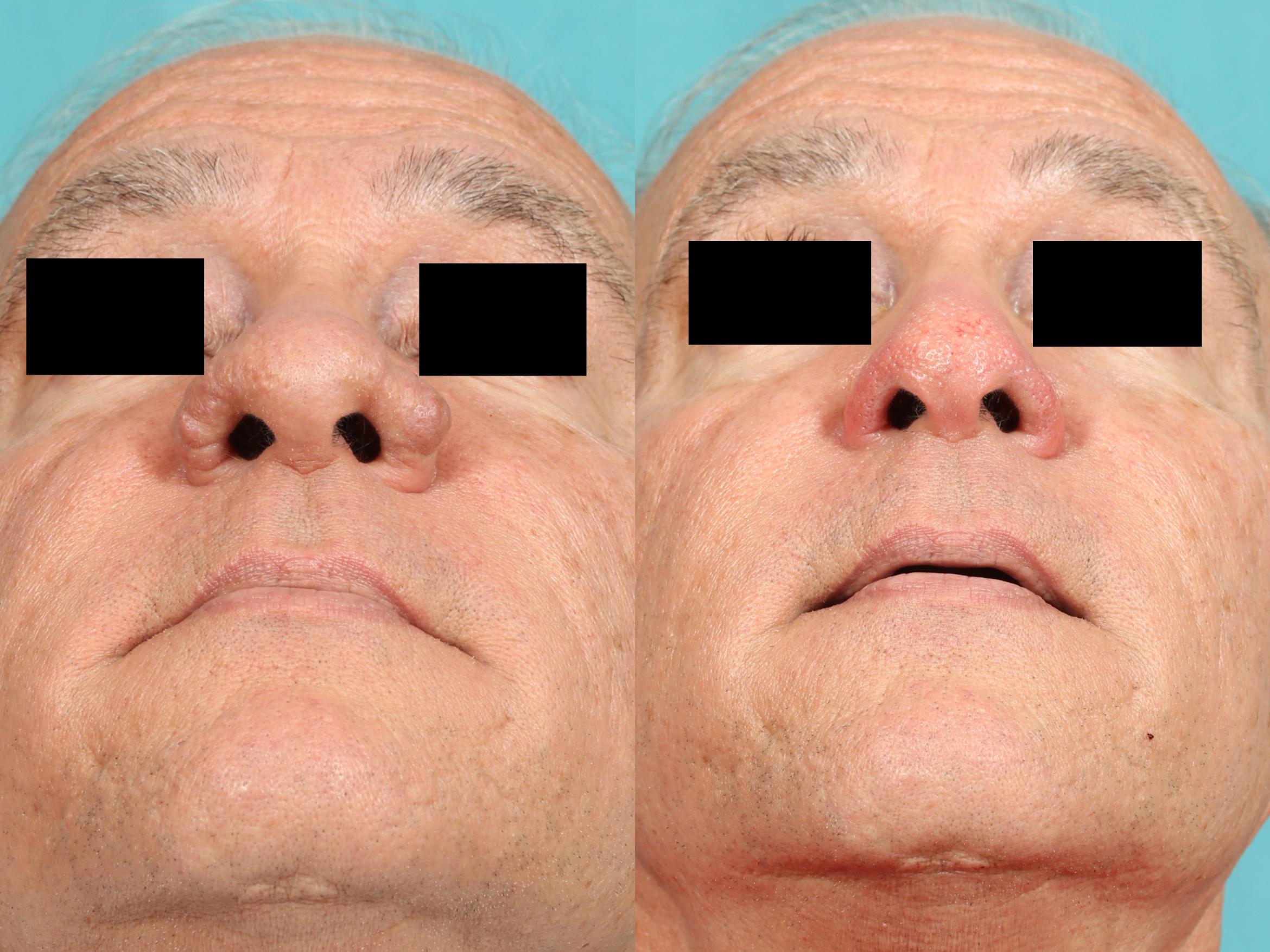 Rhinophyma Treatment- Orlando
