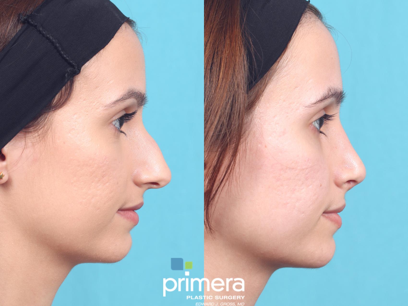 Rhinoplasty in Orlando, FL