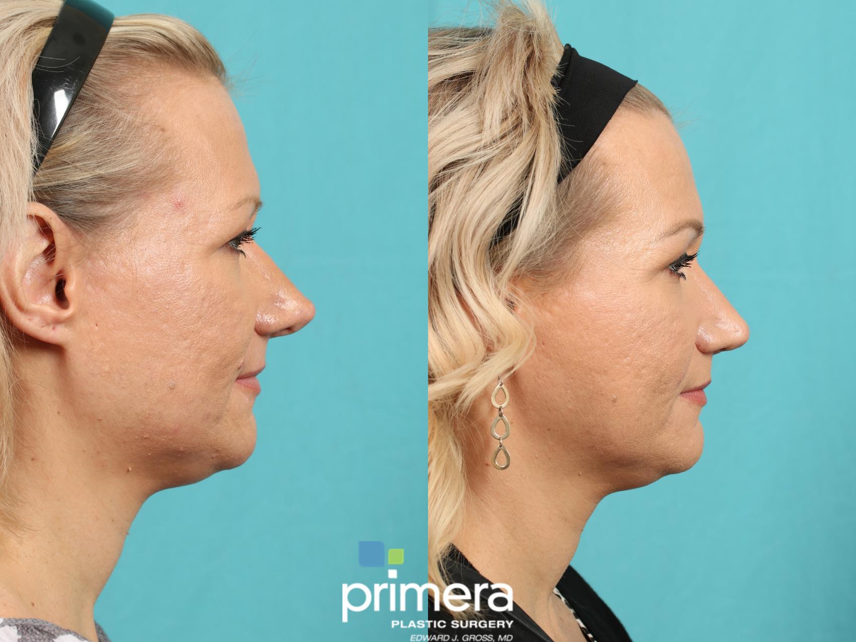 Nose Job | Orlando , FL