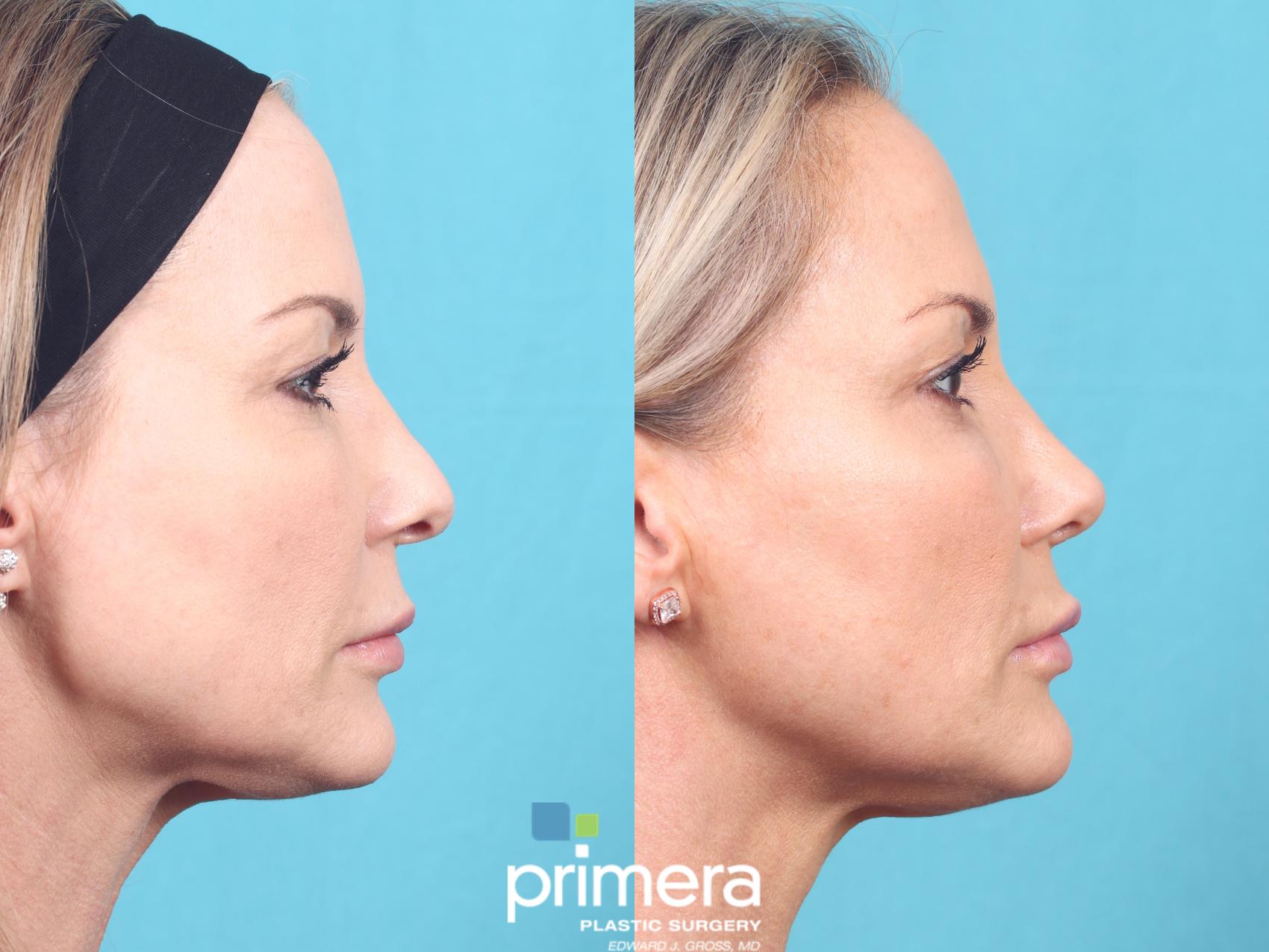 Rhinoplasty Before and After Pictures Case 667 Orlando, Florida
