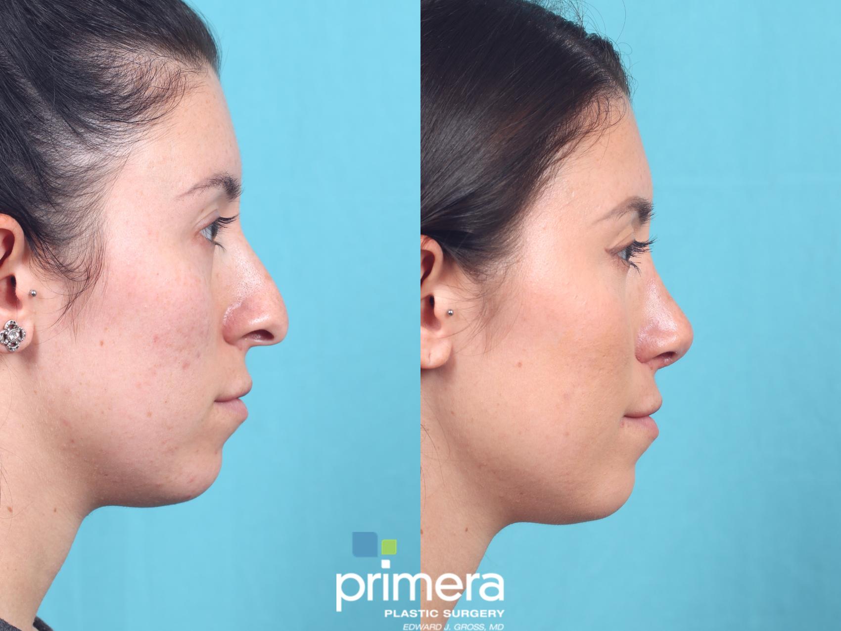 Nose Job | Orlando , FL