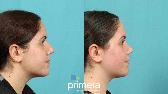 Christina | Rhinoplasty | Orlando, FL: This 22-year-old woman was bothered by the hump on her bridge, downward slope of the tip, and a crooked tilt of her nose. Dr. Gross performed a rhinoplasty with profile reduction, tip plasty, and bridge straightening. She also underwent a septal repositioning to correct the crooked tilt of her nose. She is very pleased with her results!