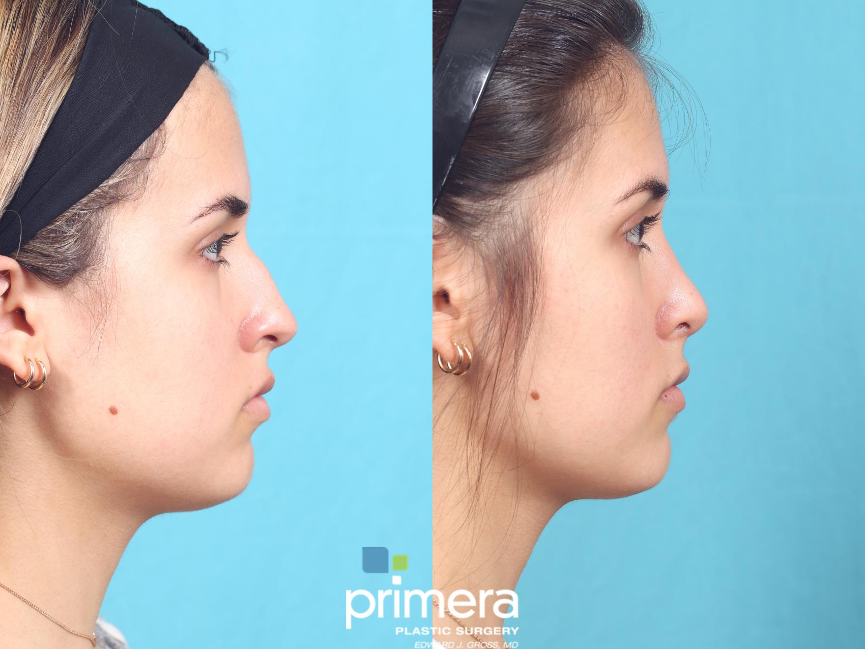 Nose Job | Orlando , FL