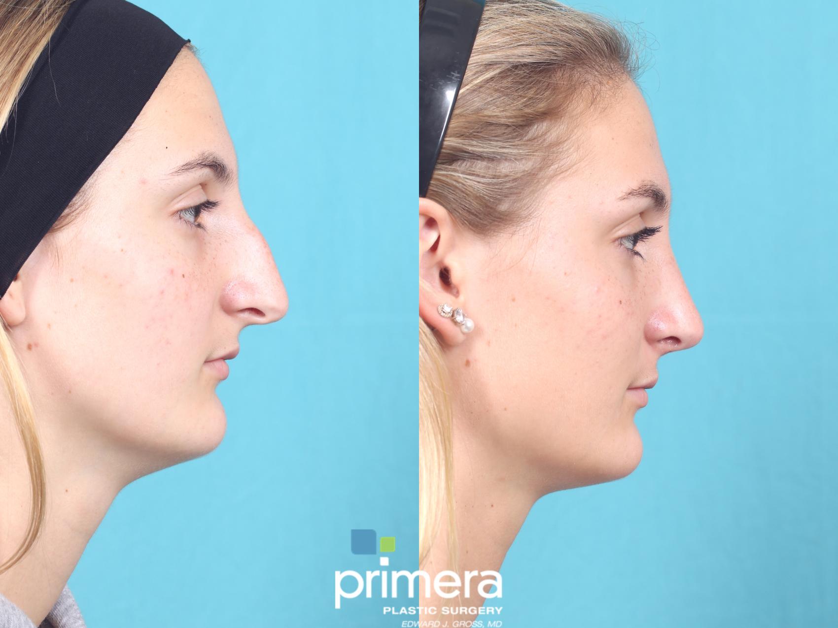 Nose Job | Orlando , FL