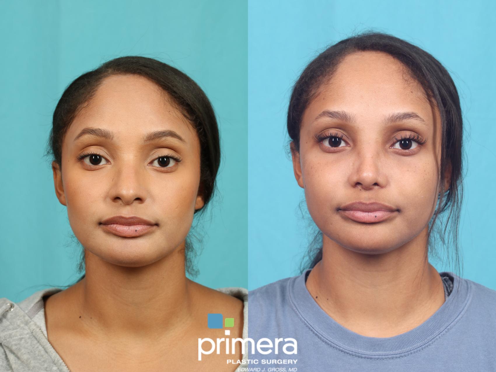 Rhinoplasty | Primera Plastic Surgery | Orlando, FL