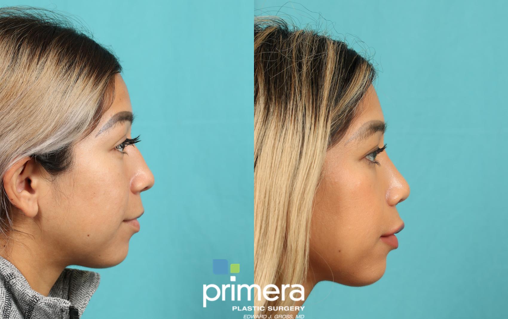 rhinoplasty-before-and-after-pictures-case-716-orlando-florida