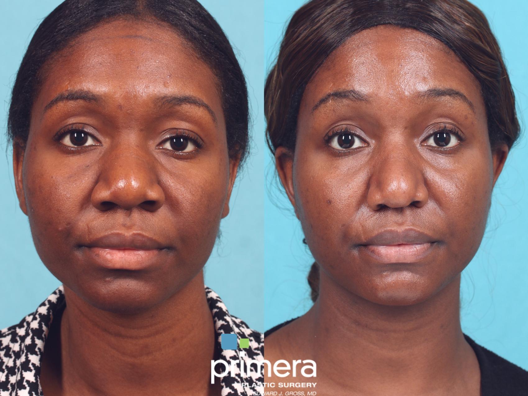 Ethnic Rhinoplasty | Before & After | Primera Plastic Surgery | Orlando, FL