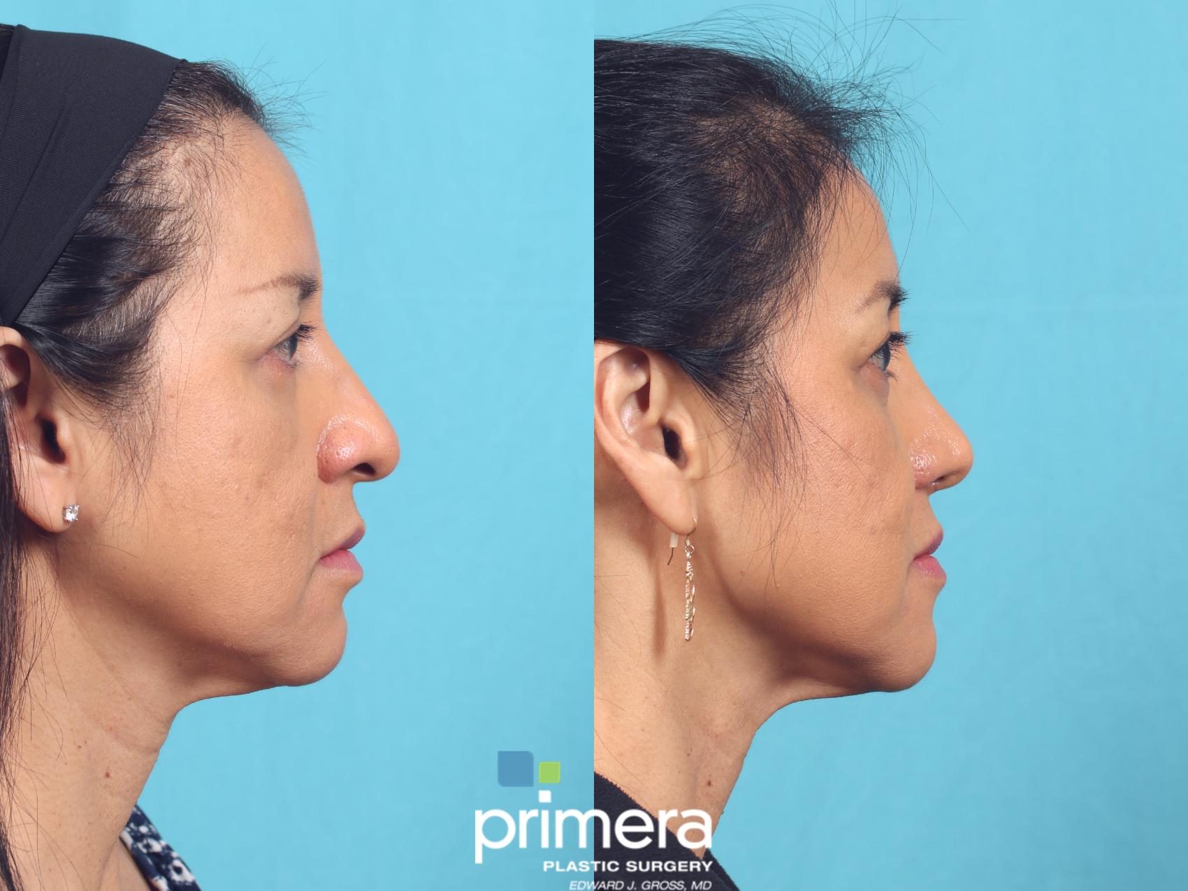 Rhinoplasty | Nose Job | Orlando , FL