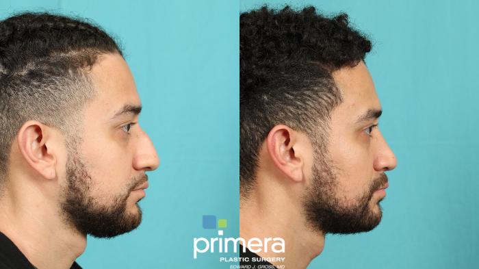 Rhinoplasty | Before and After | Primera Plastic Surgery