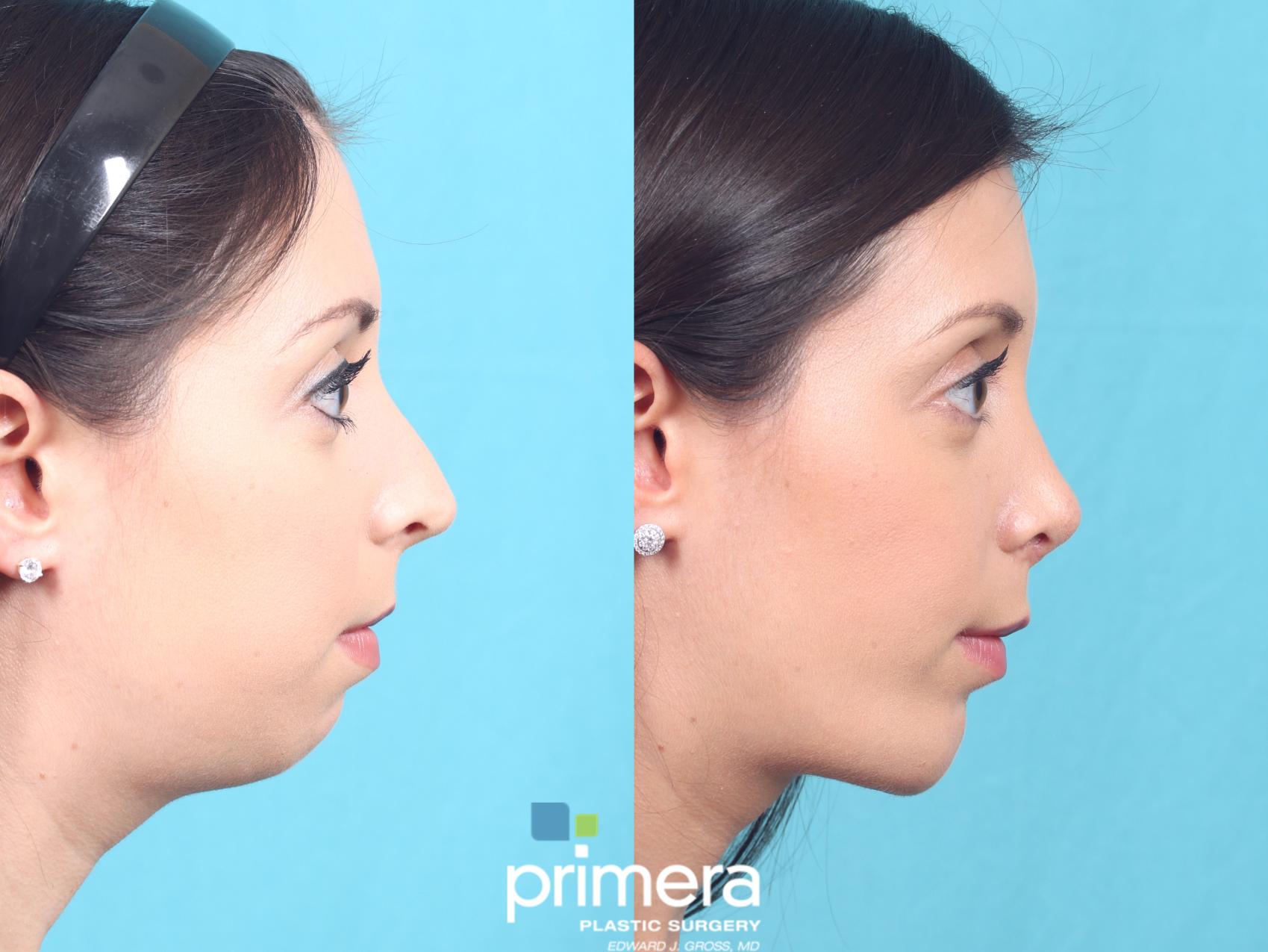 Before & After Submentoplasty (Chin Tuck) Case 759 Right Side View in Orlando, Florida