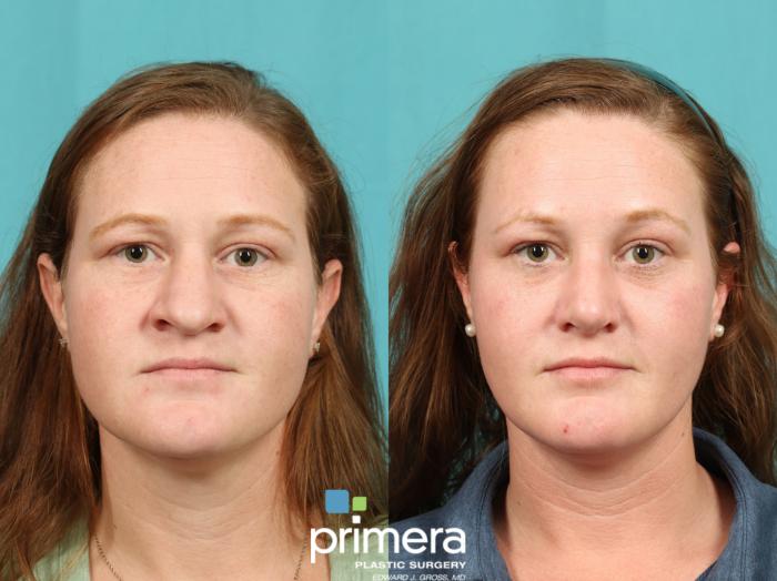 Before & After Endoscopic Forehead Lift Case 780 Front View in Orlando, Florida
