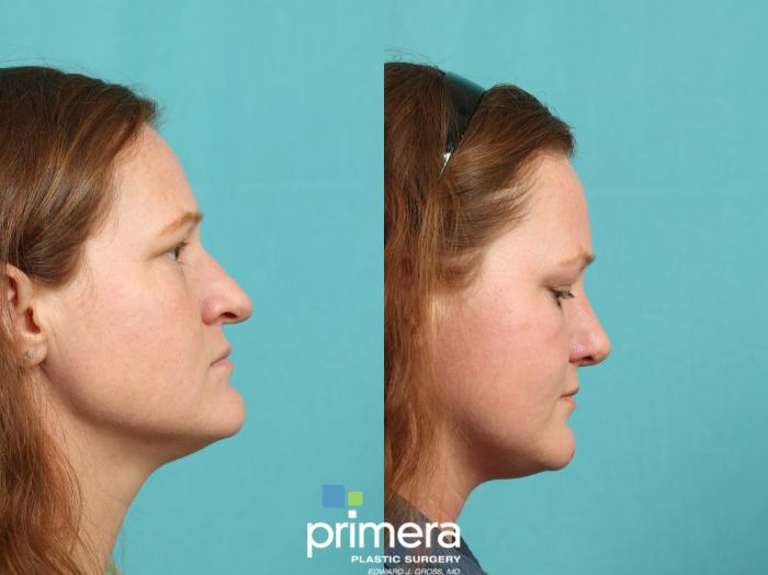 Before & After Endoscopic Forehead Lift Case 780 Right Side View in Orlando, Florida