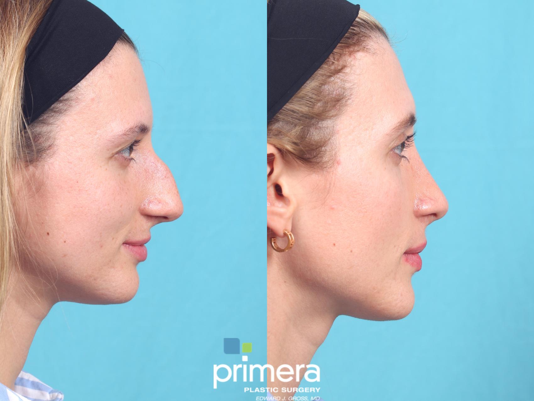 Rhinoplasty | Nose Job | Orlando , FL