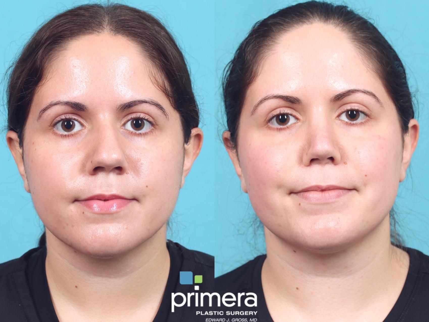 Rhinoplasty | Nose Job | Orlando , FL