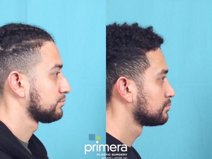 Before & After Rhinoplasty Case 828 Right Side View in Orlando, Florida