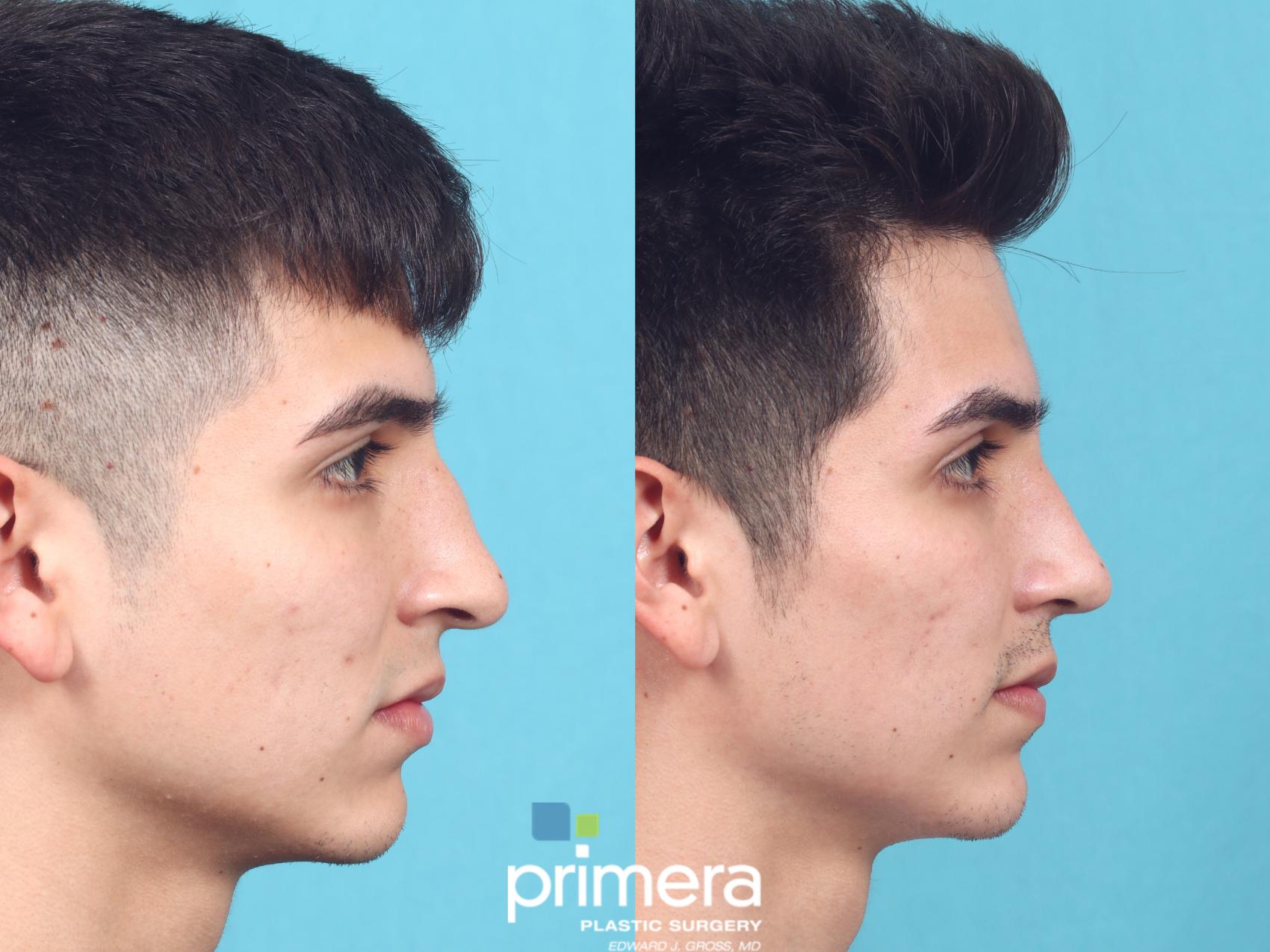 Rhinoplasty | Before & After | Dr. Edward Gross | Primera Plastic Surgery