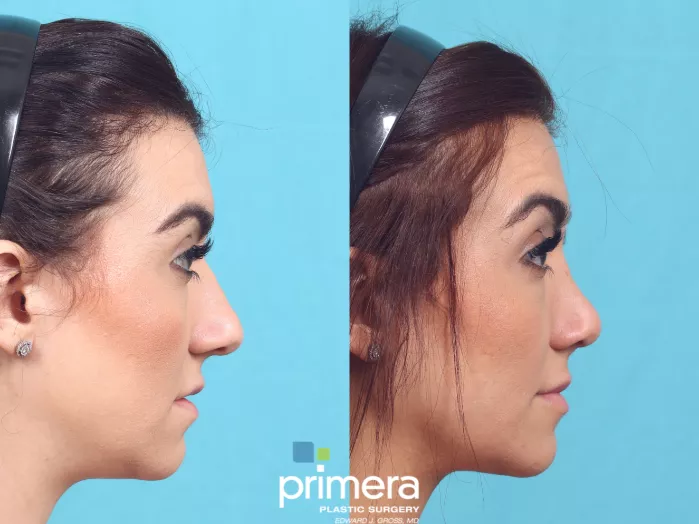 rhinoplasty-833-right-side-