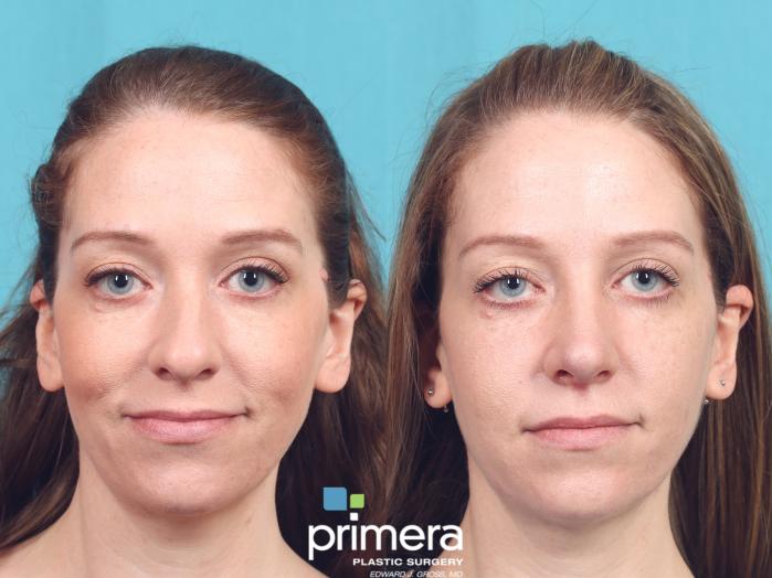 Rhinoplasty | Before & After | Dr. Edward Gross | Primera Plastic Surgery