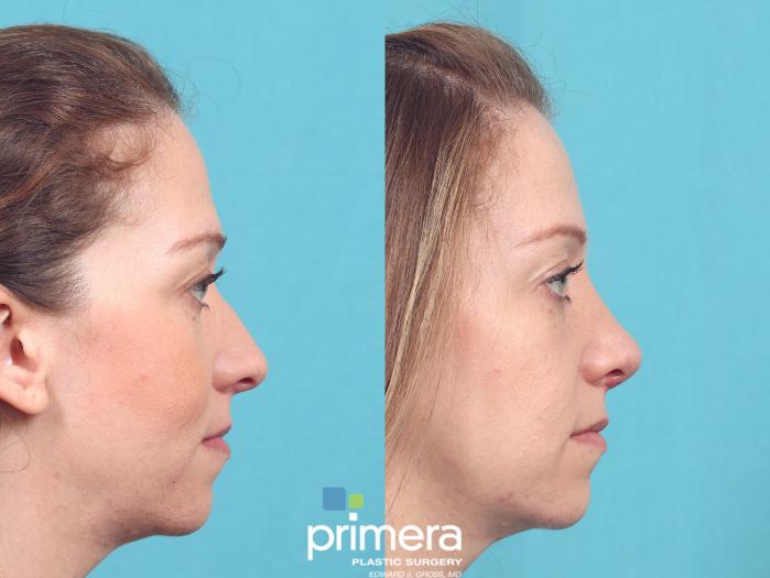 Rhinoplasty | Before & After | Dr. Edward Gross | Primera Plastic Surgery