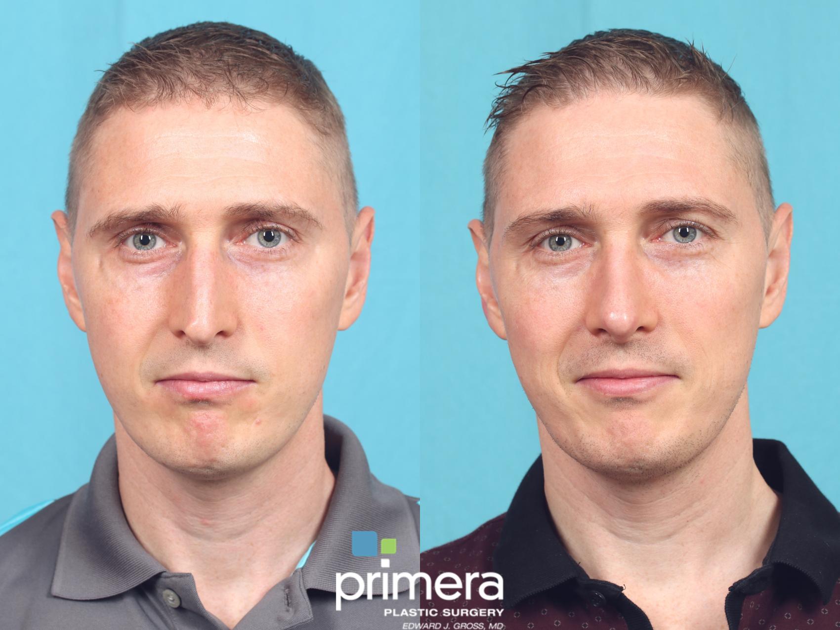 Before & After Rhinoplasty Case 862 Front View in Orlando, Winter Park & Tampa, Florida