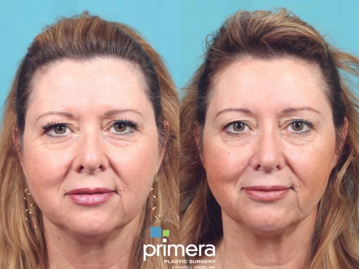 Before & After Brow Lift Case 863 Front View in Orlando, Florida
