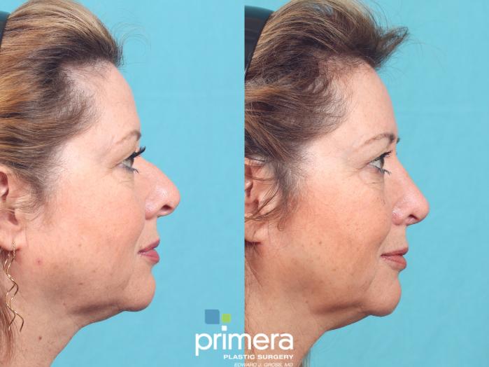 Before & After Brow Lift Case 863 Right Side View in Orlando, Florida