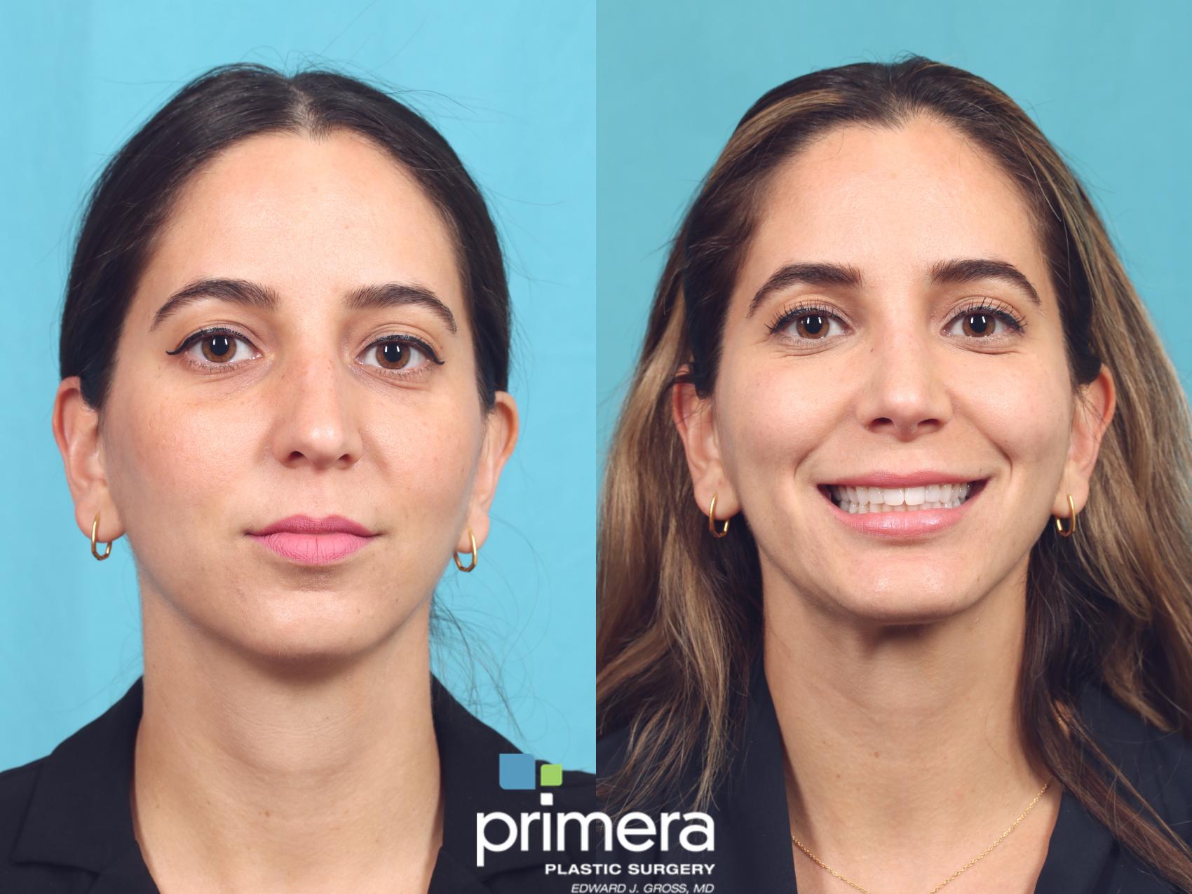 Before & After Chin & Cheek Implant Case 871 Front View in Orlando, Florida