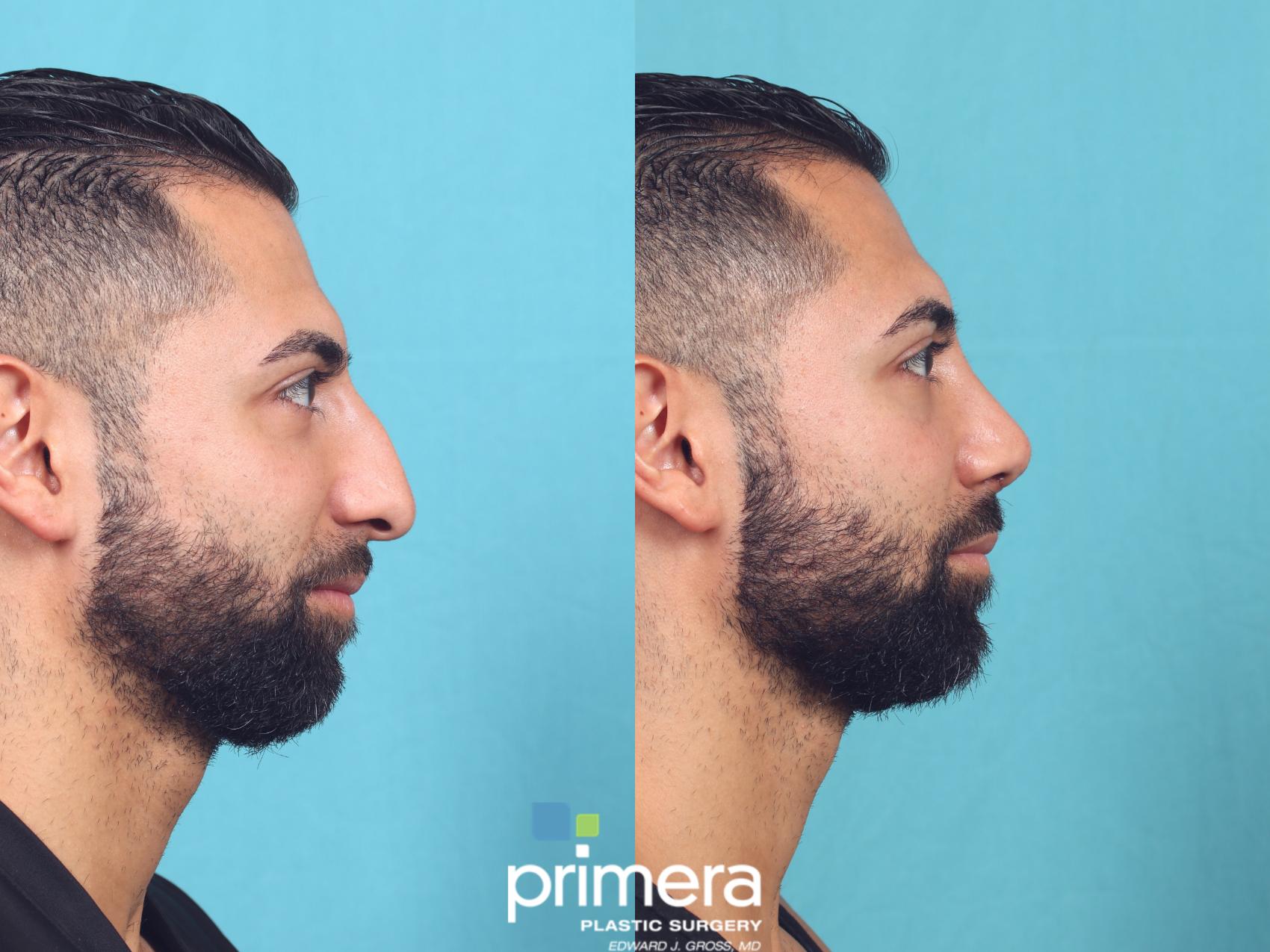 Rhinoplasty | Nose Job | Orlando , FL