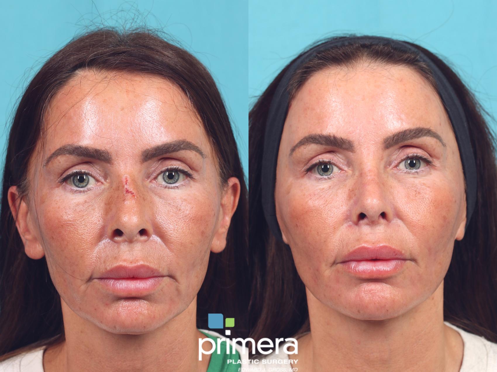 Rhinoplasty Before and After Pictures Case 877 Orlando, Florida