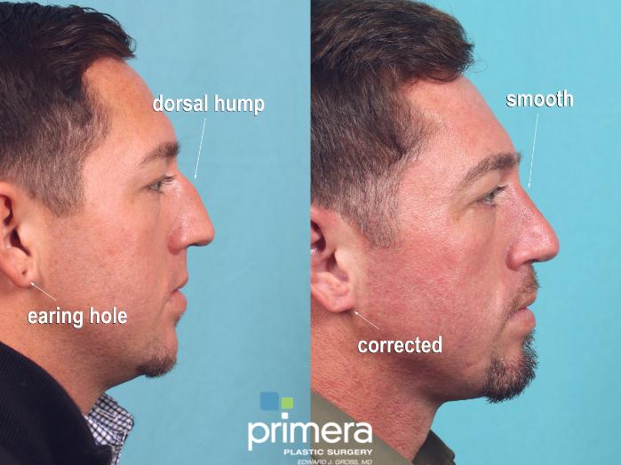 Before & After Rhinoplasty Case 882 Right Side View in Orlando, Florida