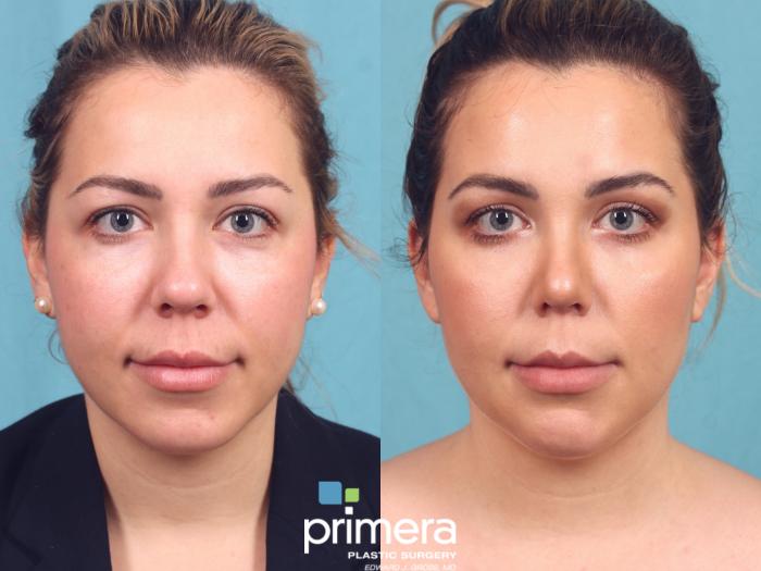 Before & After Chin & Cheek Implant Case 887 Front View in Orlando, Florida