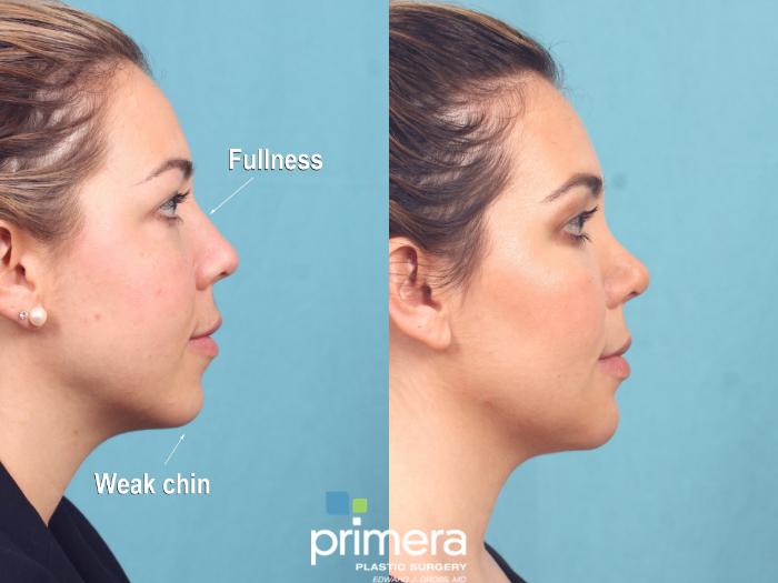 Before & After Chin & Cheek Implant Case 887 Right Side View in Orlando, Florida