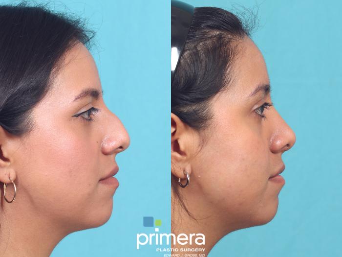 Rhinoplasty | Nose Job | Primera Plastic Surgery | Orlando, FL