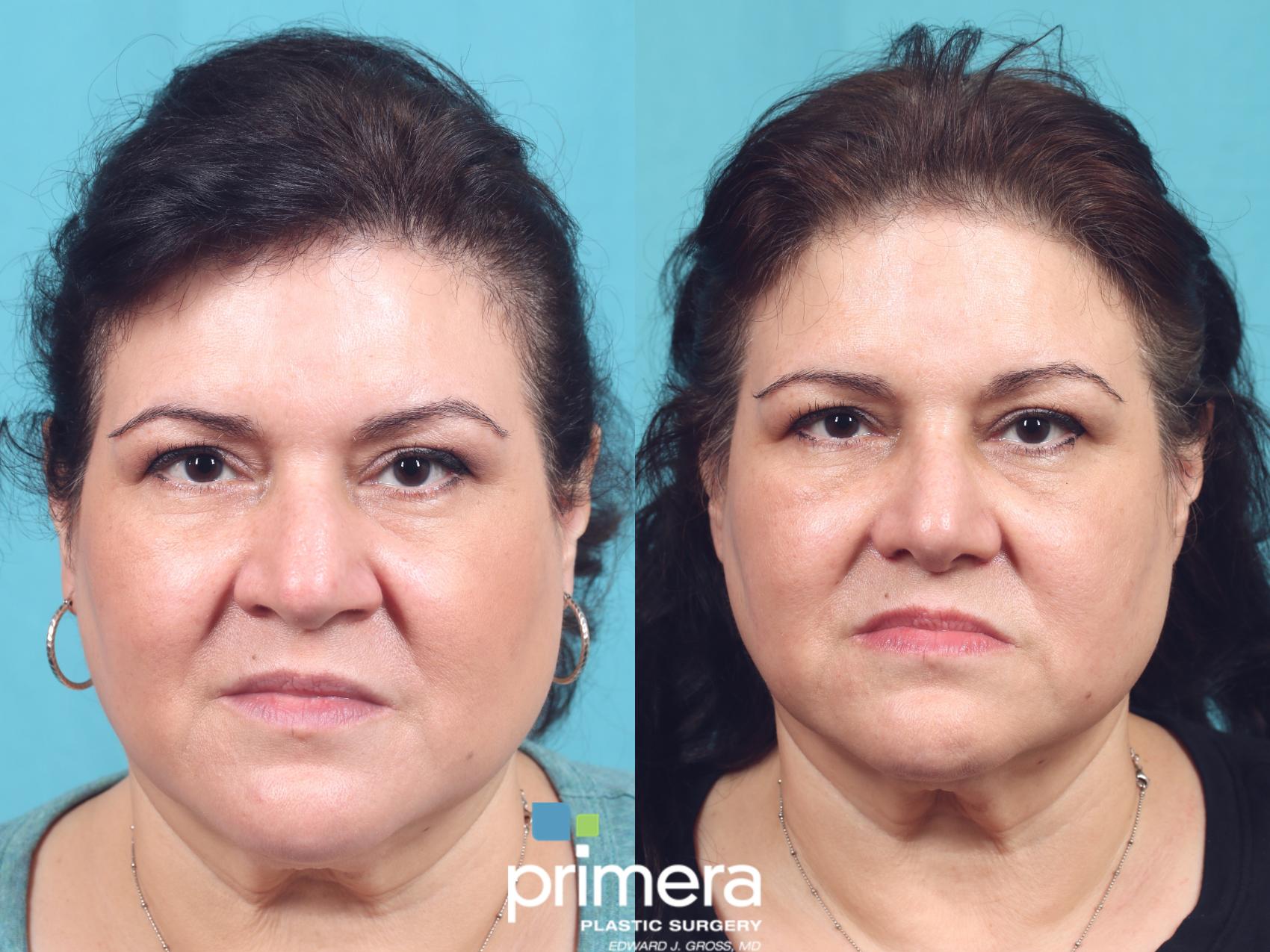 Rhinoplasty Before and After Pictures Case 892 Orlando, Florida