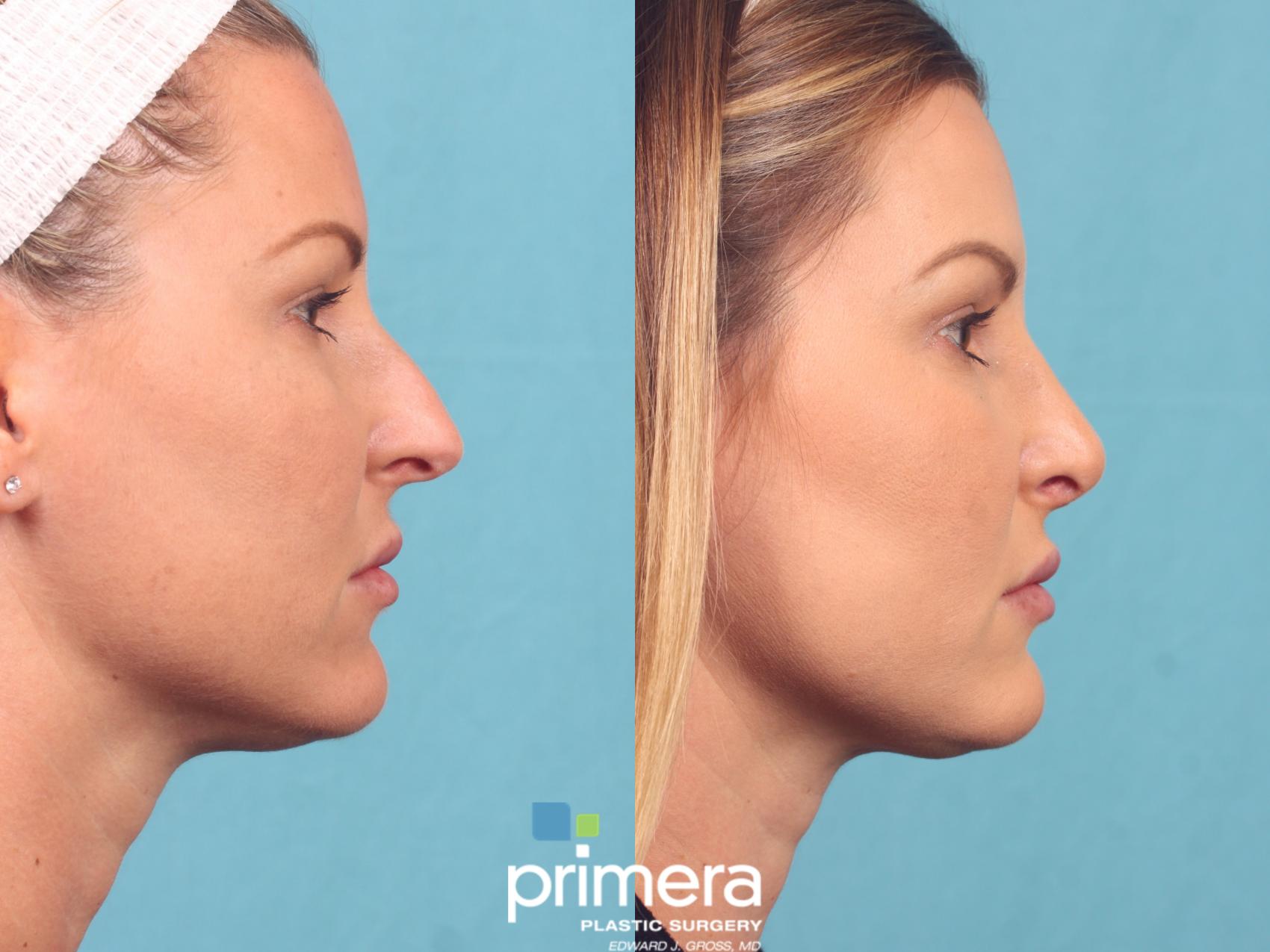 Rhinoplasty Before and After Pictures Case 910 Orlando, Florida