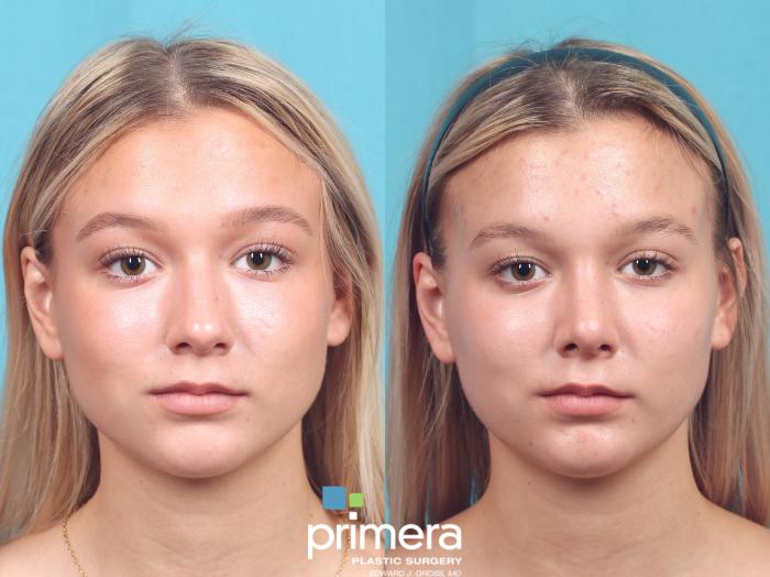 Before & After Rhinoplasty Case 915 Front View in Orlando, Florida