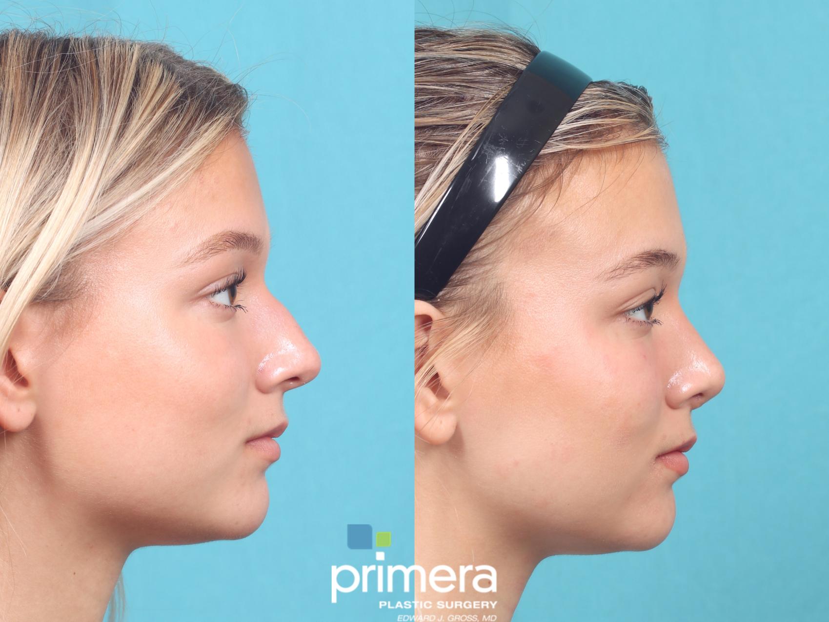 Before & After Rhinoplasty Case 915 Right Side View in Orlando, Florida