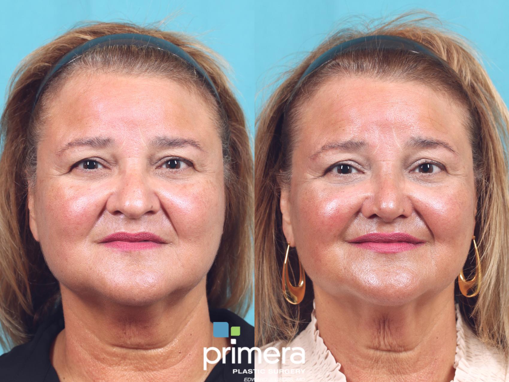 Before & After Rhinoplasty Case 918 Front View in Orlando, Florida