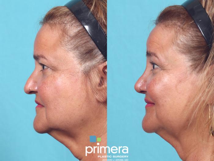 Before & After Rhinoplasty Case 918 Left Side View in Orlando, Florida