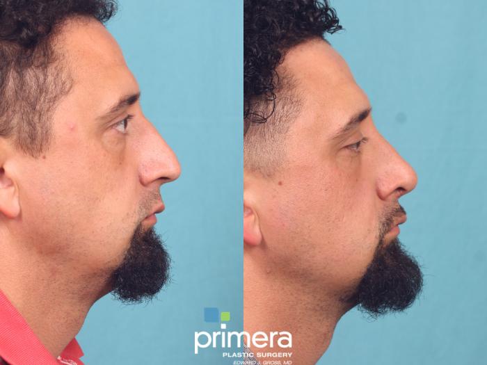 Before & After Rhinoplasty Case 922 Right Side View in Orlando, Florida