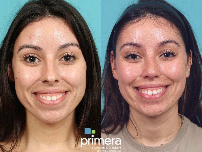Before & After Rhinoplasty Case 926 Front View in Orlando, Florida