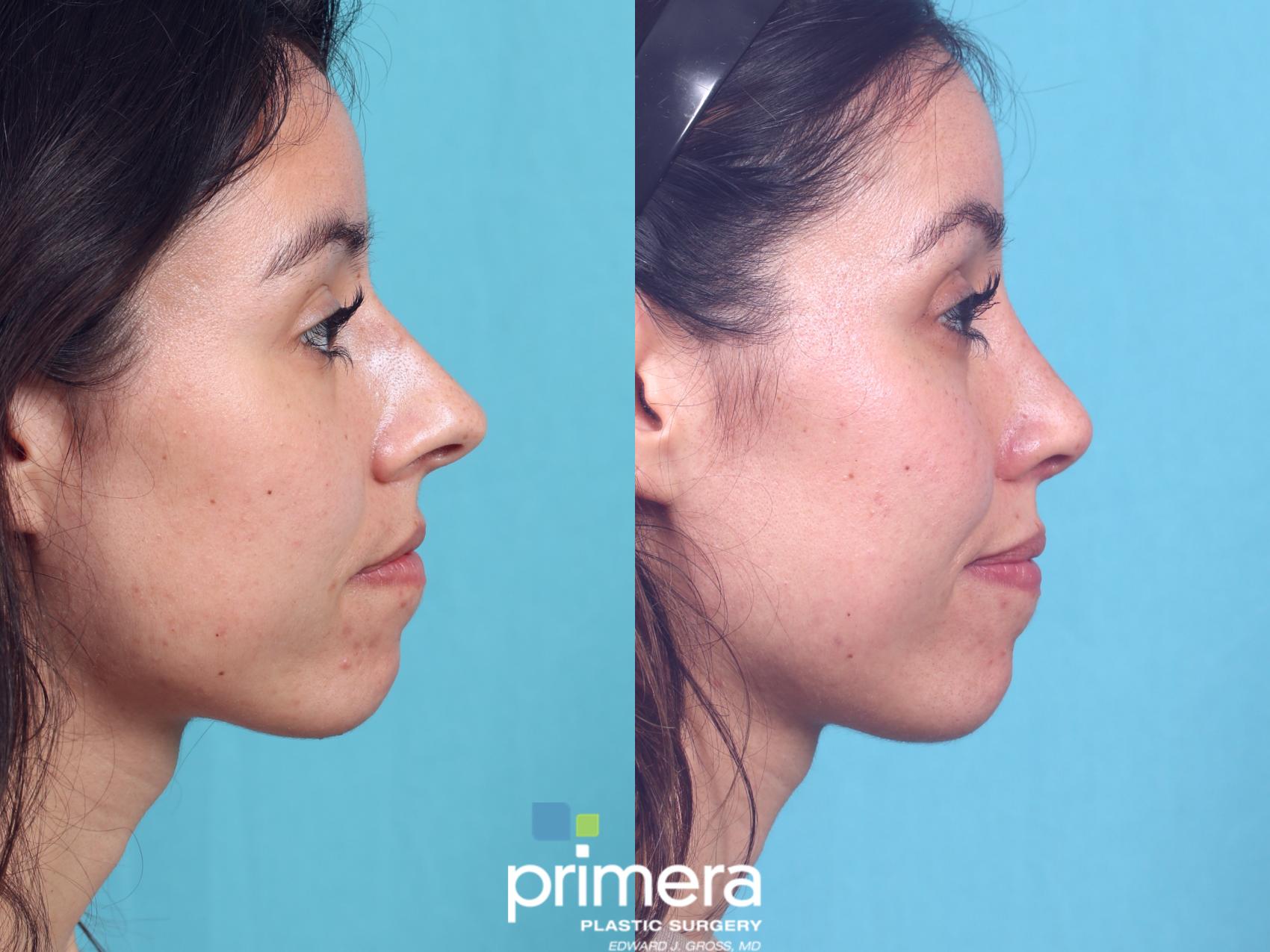 Before & After Rhinoplasty Case 926 Right Side View in Orlando, Florida