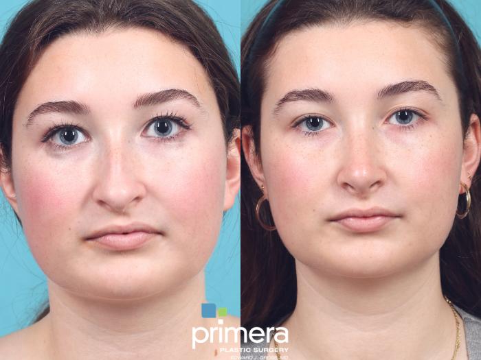 Before & After Rhinoplasty Case 928 Front View in Orlando, Florida