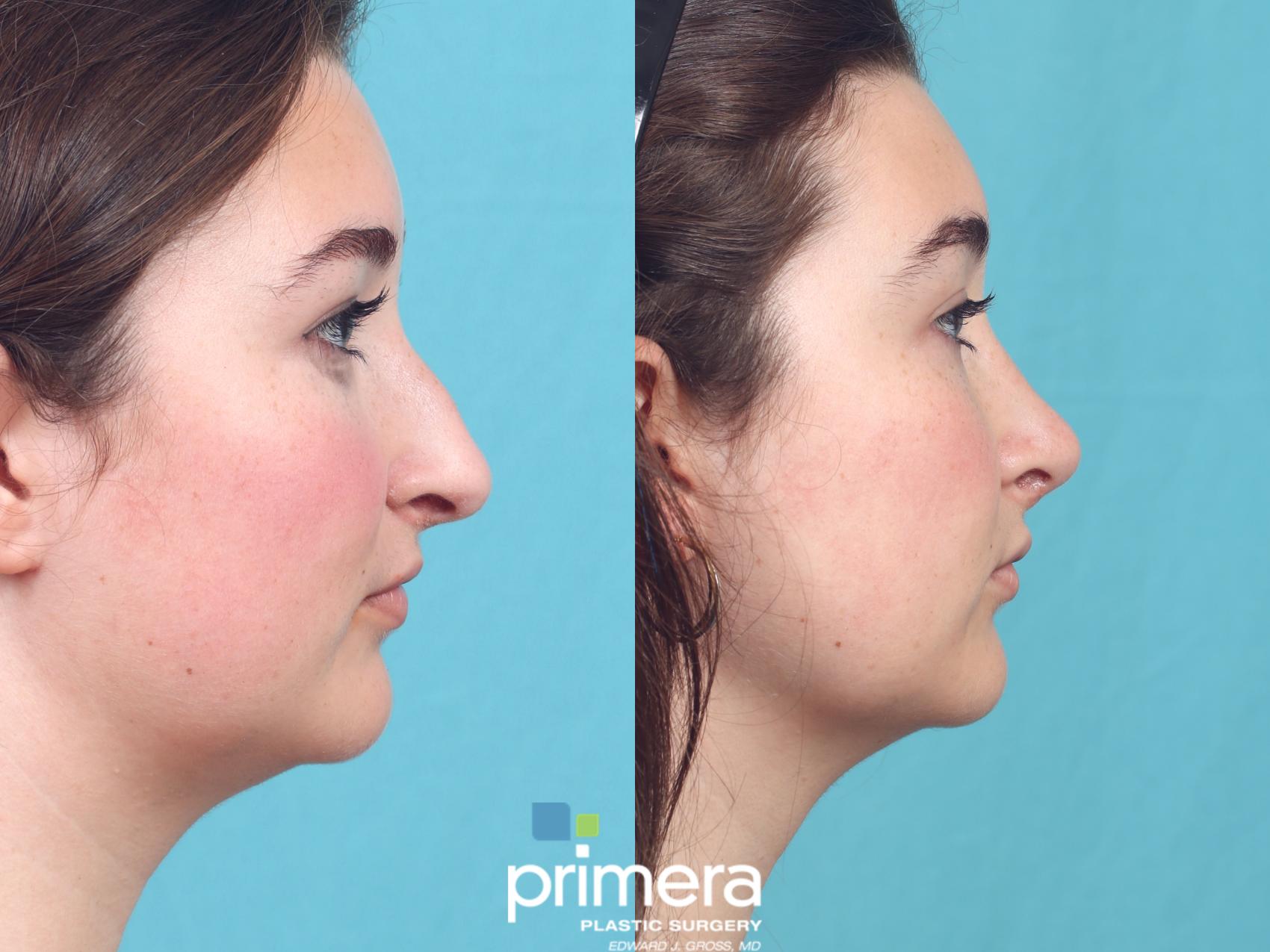 Before & After Rhinoplasty Case 928 Right Side View in Orlando, Florida