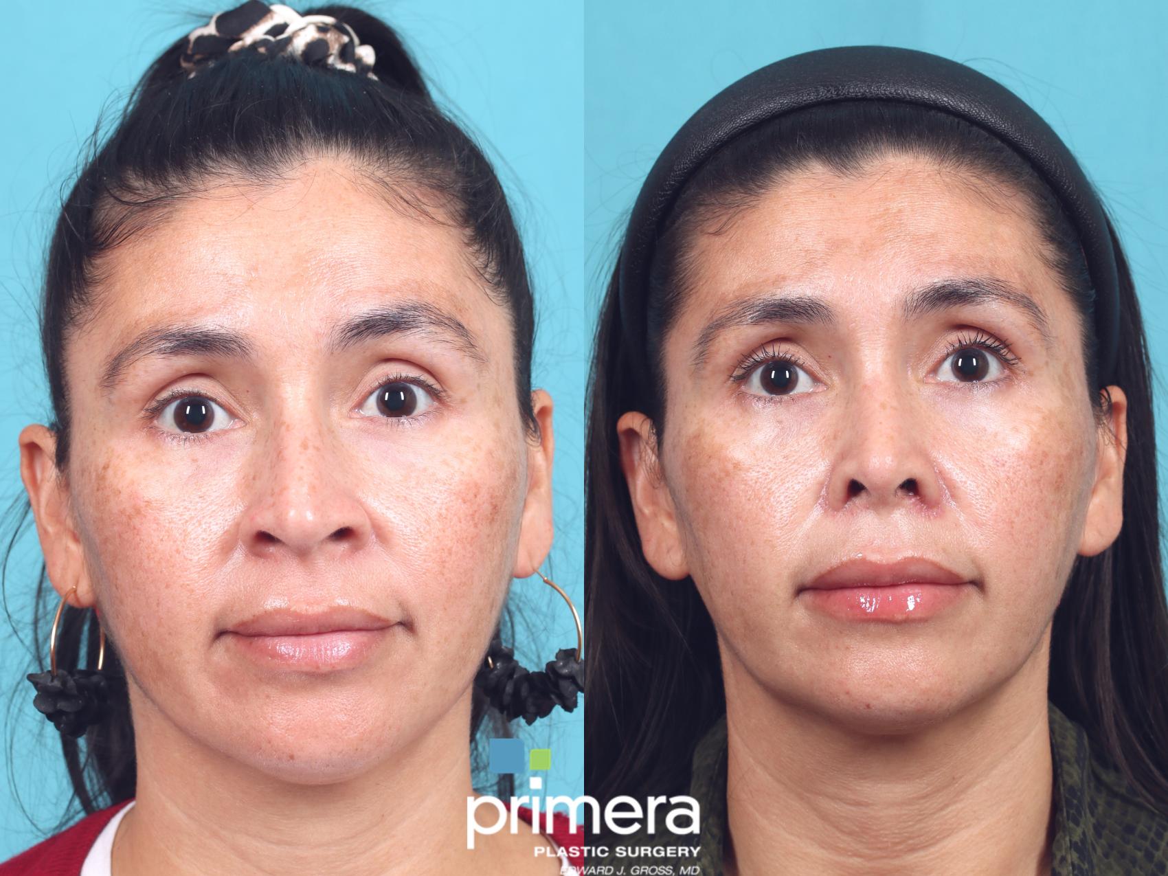 Before & After Rhinoplasty Case 929 Front View in Orlando, Florida