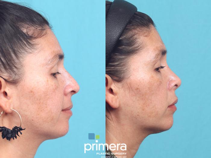 Before & After Rhinoplasty Case 929 Right Side View in Orlando, Florida
