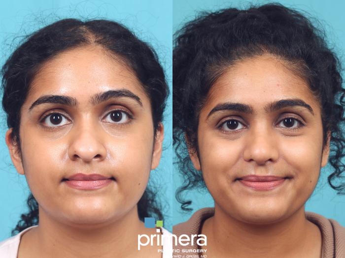 Before & After Rhinoplasty Case 931 Front View in Orlando, Florida