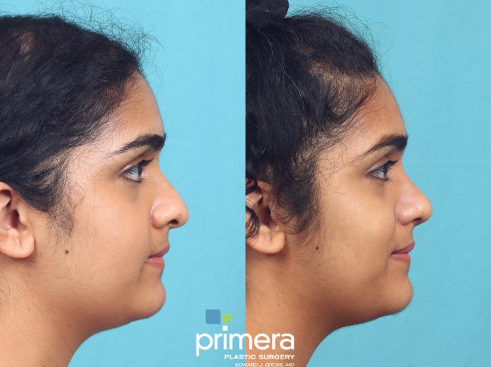 Before & After Rhinoplasty Case 931 Right Side View in Orlando, Florida