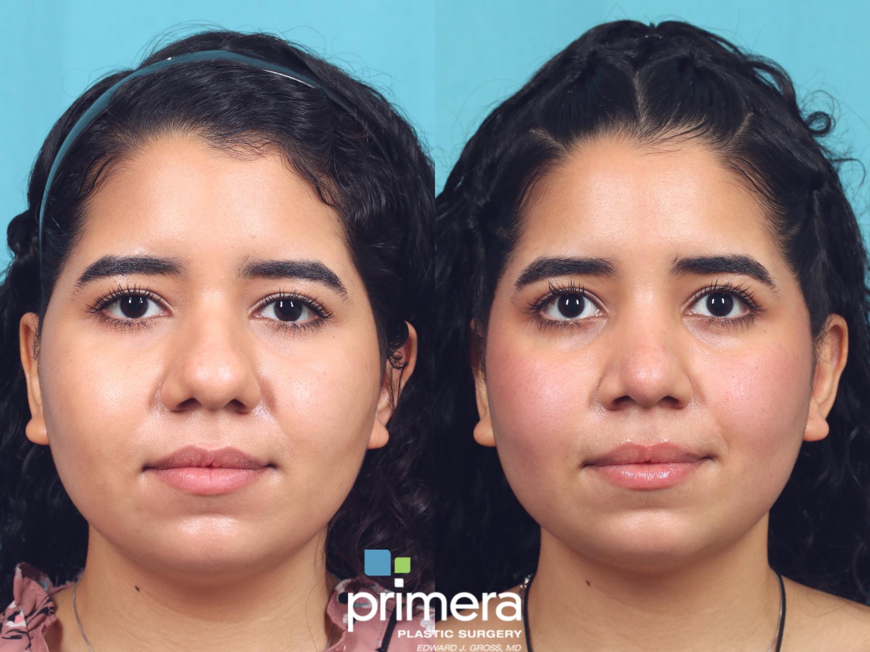 Before & After Rhinoplasty Case 934 Front View in Orlando, Florida