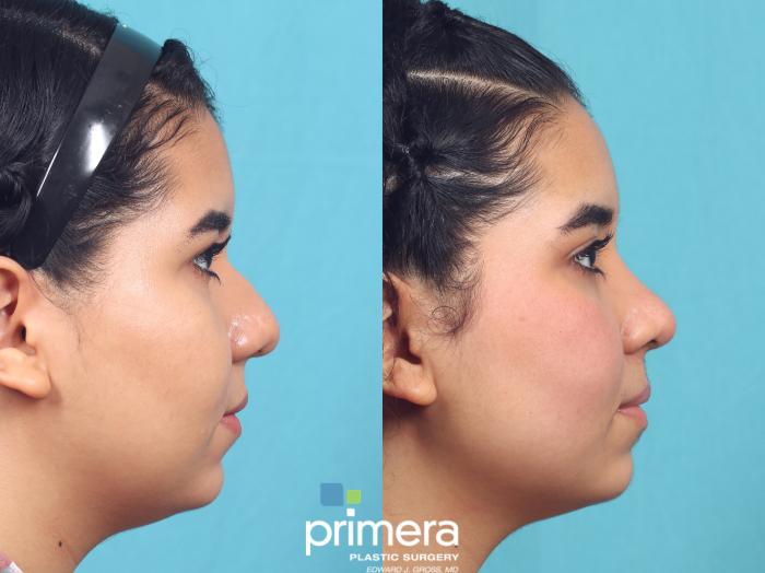 Before & After Rhinoplasty Case 934 Right Side View in Orlando, Florida
